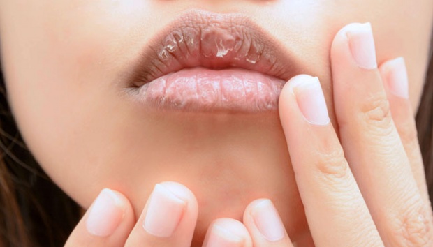 Lakukan 6 Cara Alami Ini untuk Mengatasi Bibir Kering!